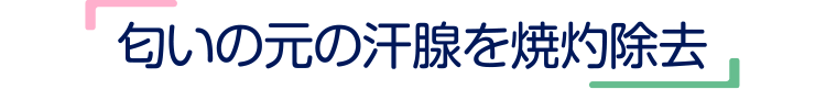 匂いの元の汗腺を焼灼除去